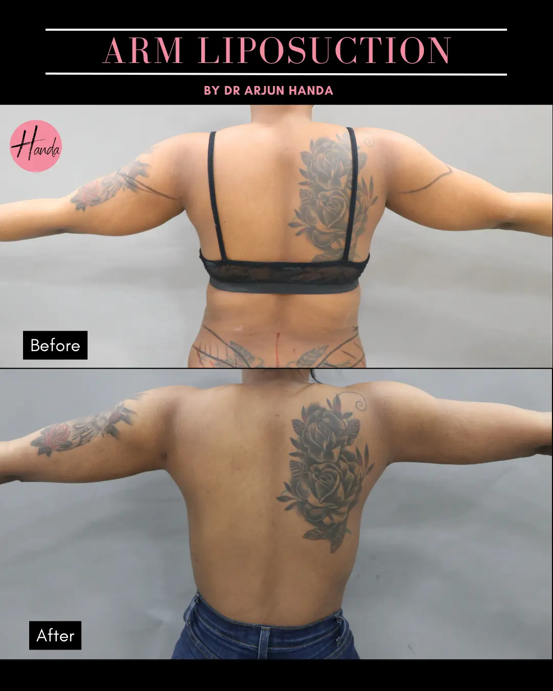 Arms & Thighs Lift before and after — Handa Aesthetics