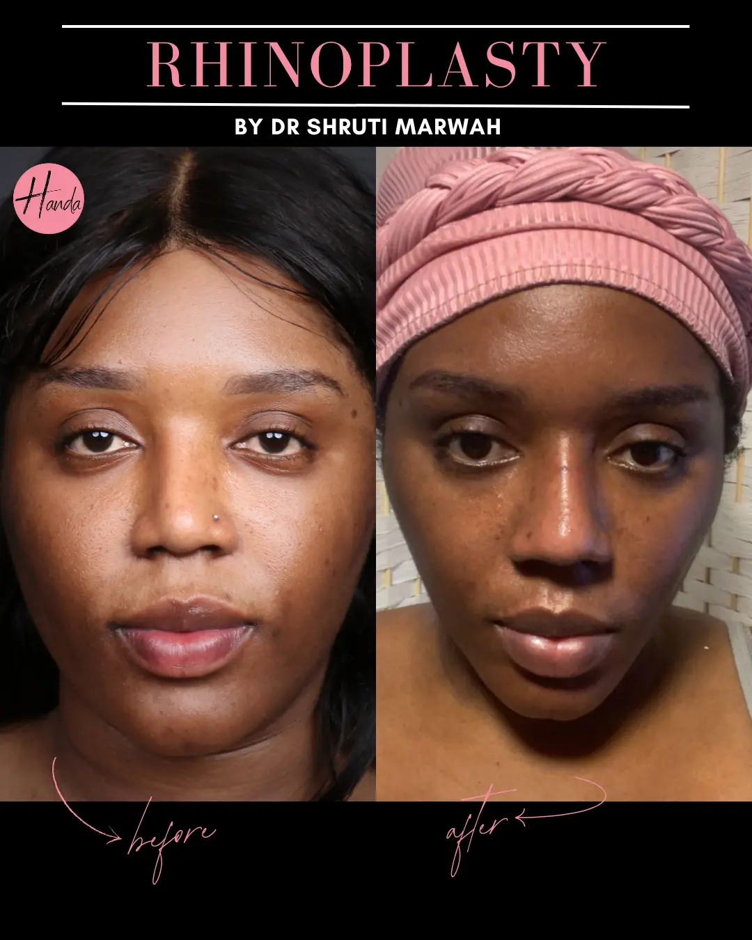 RHINOPLASTY before and after — Handa Aesthetics