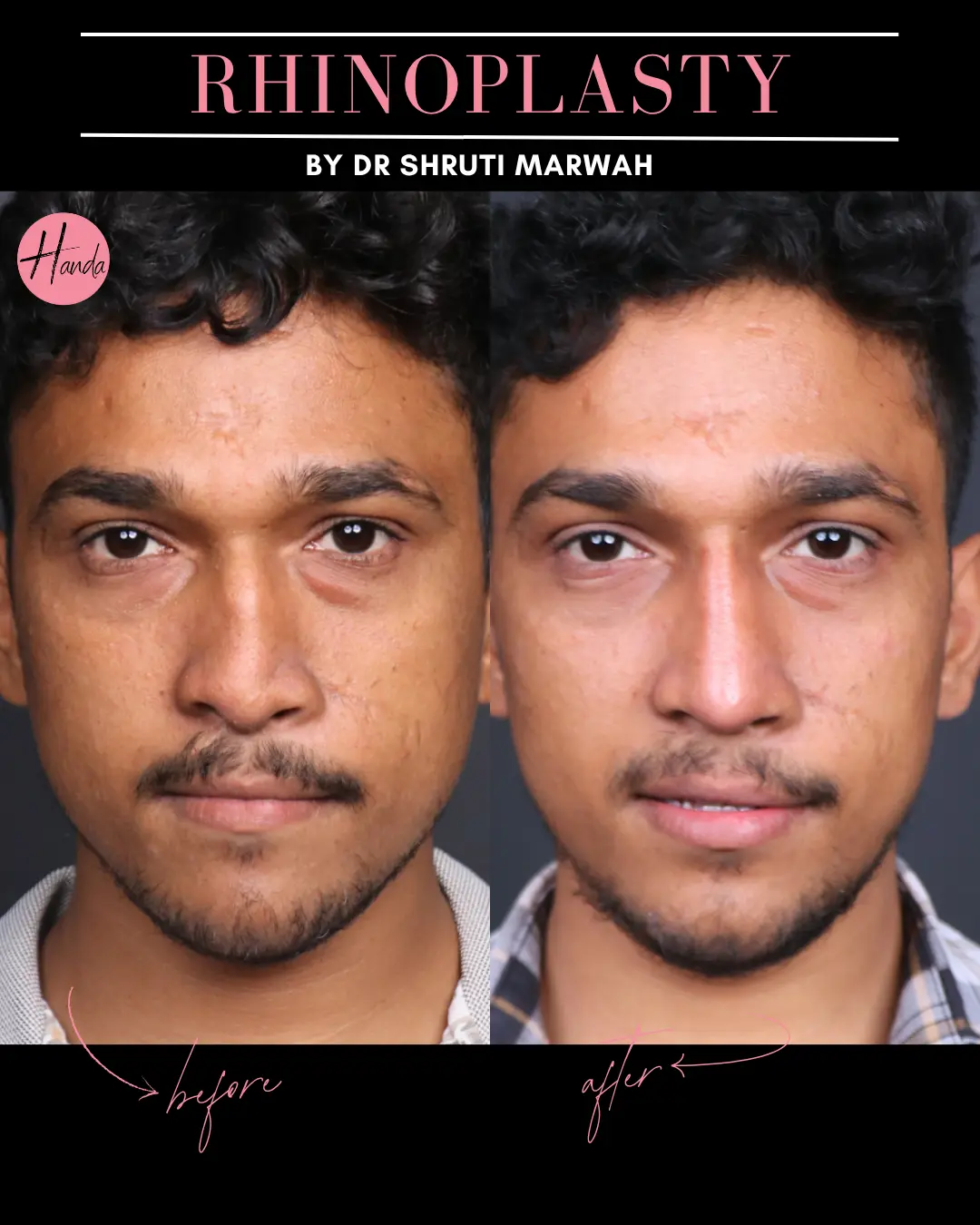 RHINOPLASTY before and after — Handa Aesthetics