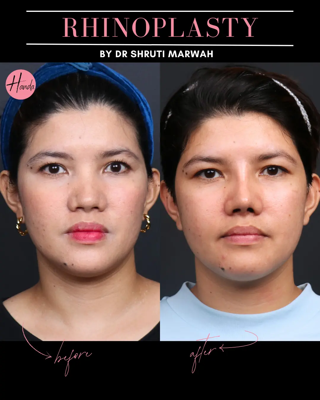 RHINOPLASTY before and after — Handa Aesthetics