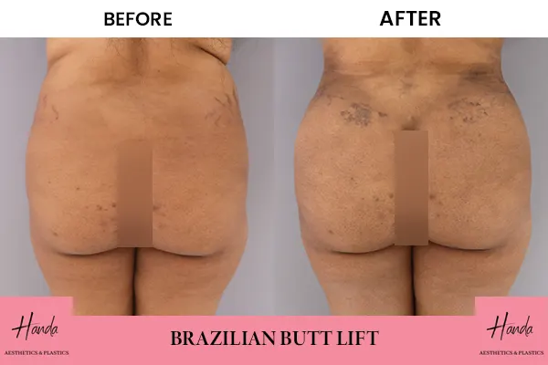 Butt Lift before and after — Handa Aesthetics