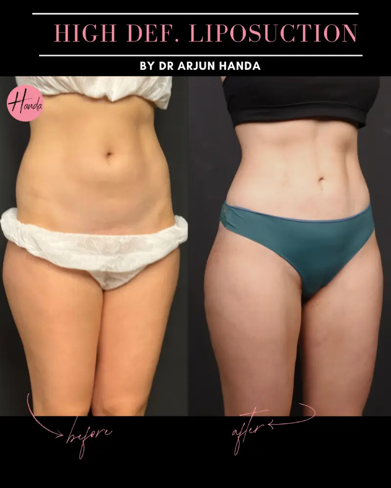 Liposuction before and after — Handa Aesthetics