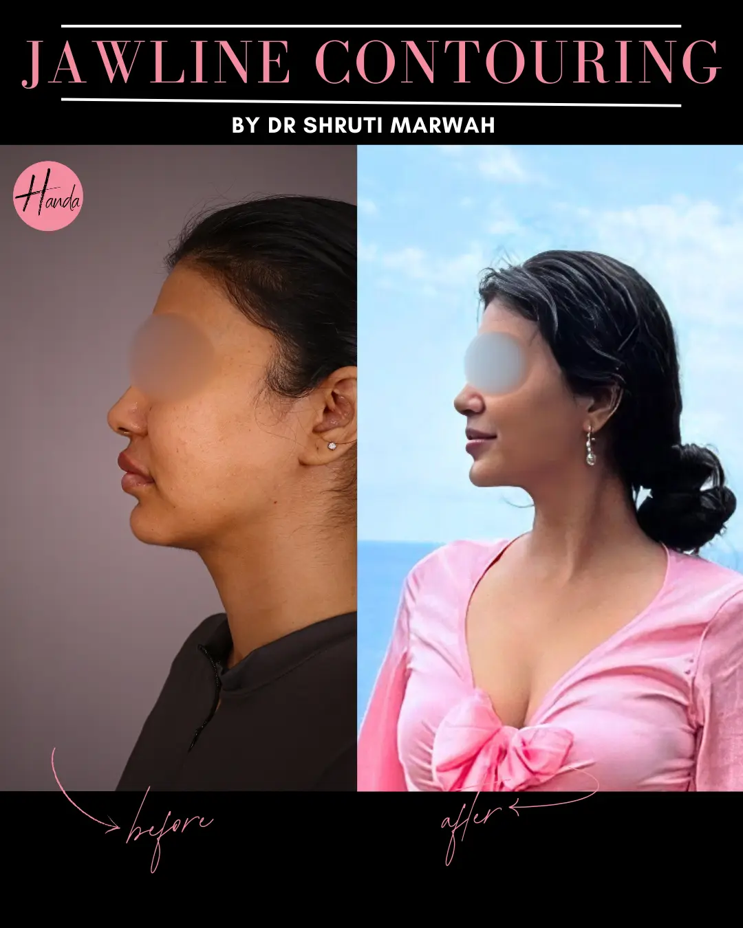 CHIN & JAWLINE LIPOSUCTION before and after — Handa Aesthetics