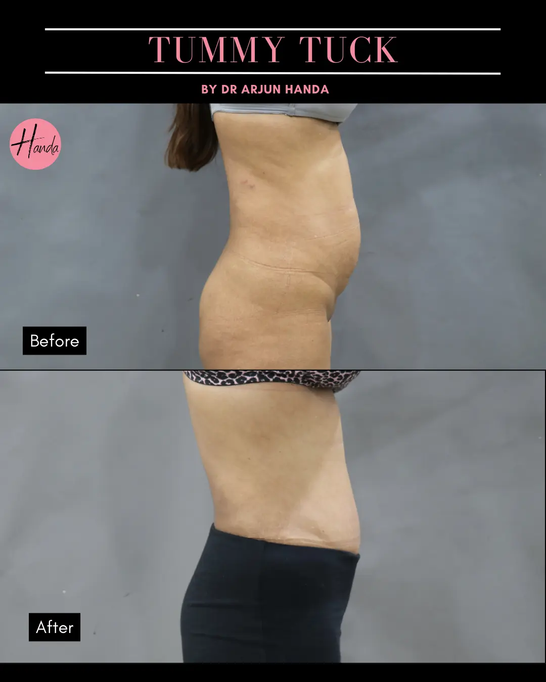 Tummy Tuck (Full Abdominoplasty) before and after — Handa Aesthetics