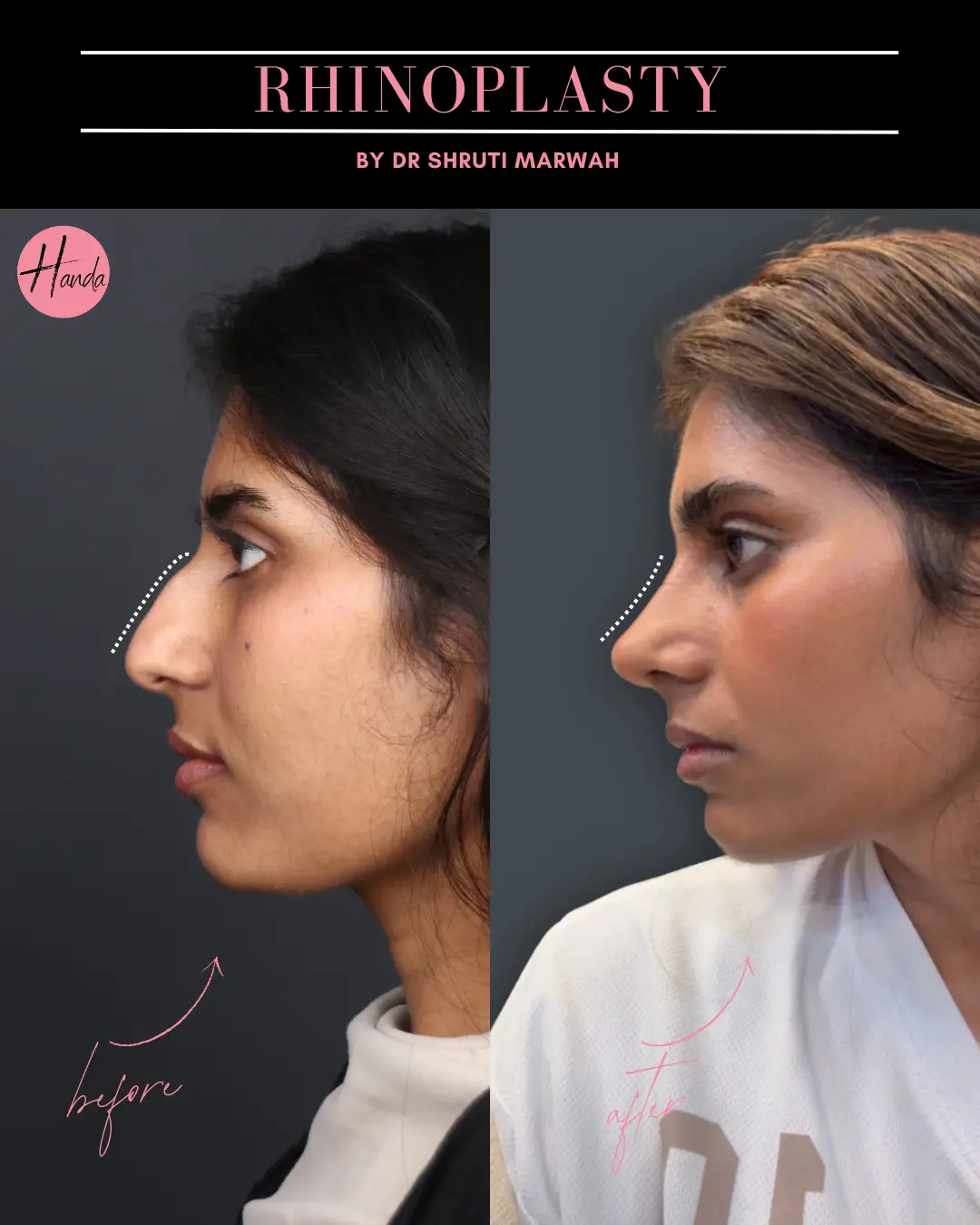 RHINOPLASTY before and after — Handa Aesthetics