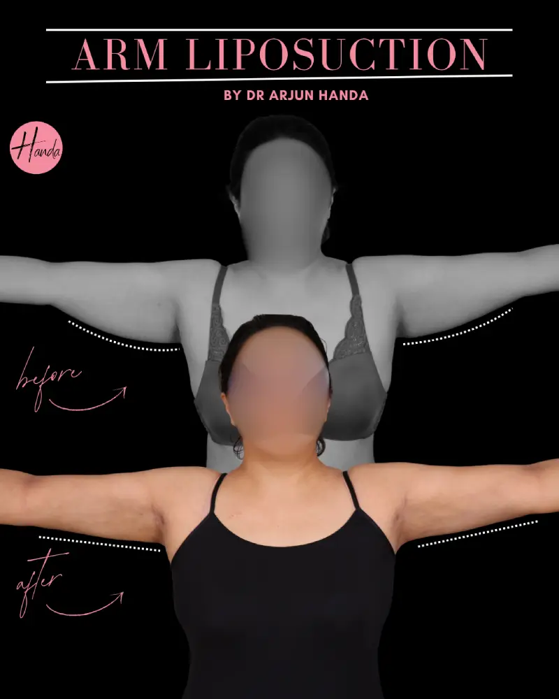 Arms & Thighs Lift before and after — Handa Aesthetics
