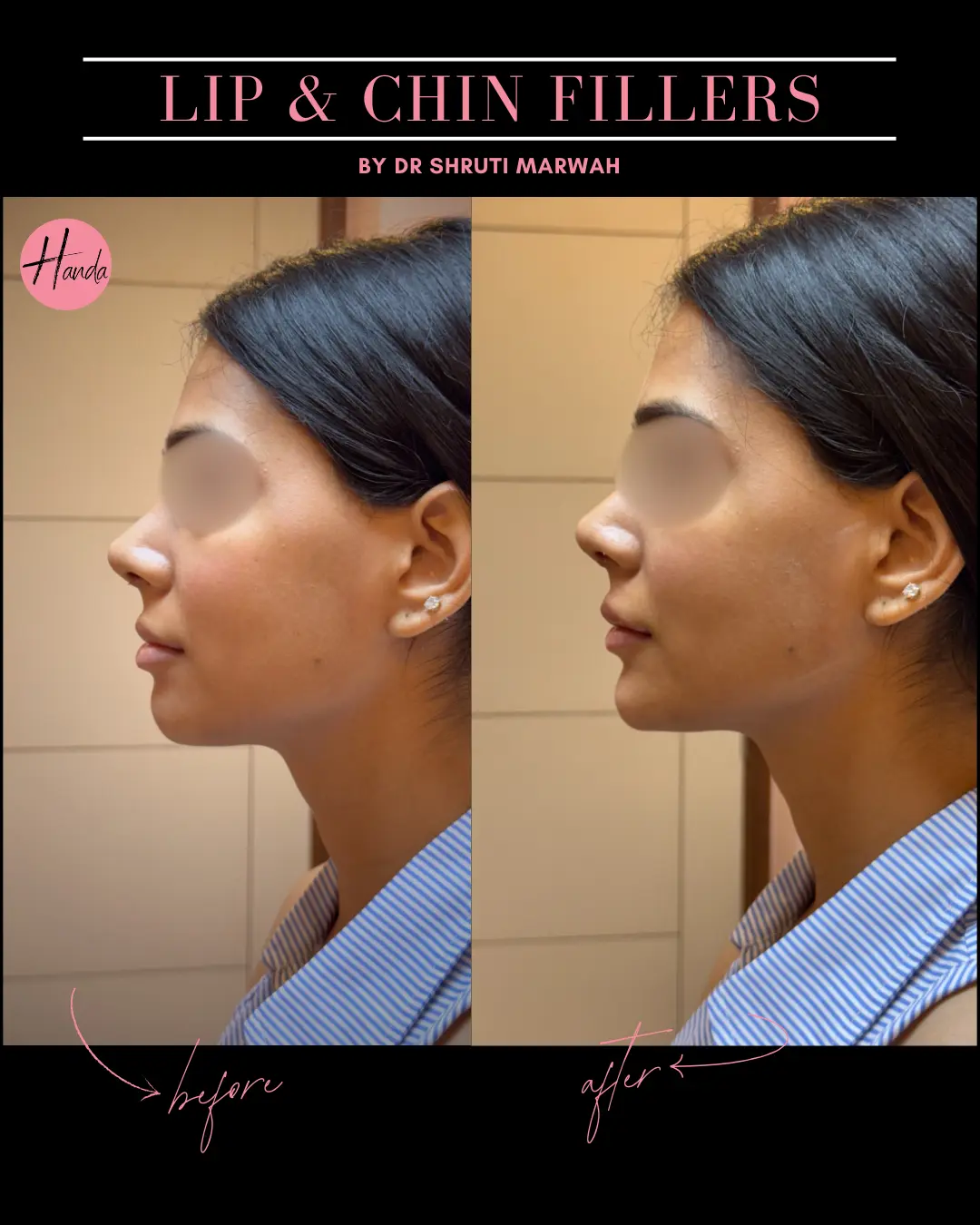CHIN & LIP FILLERS before and after — Handa Aesthetics