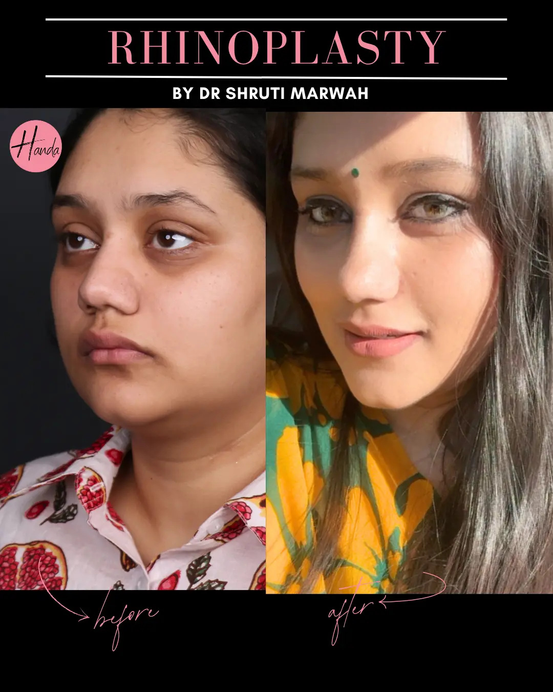 RHINOPLASTY before and after — Handa Aesthetics
