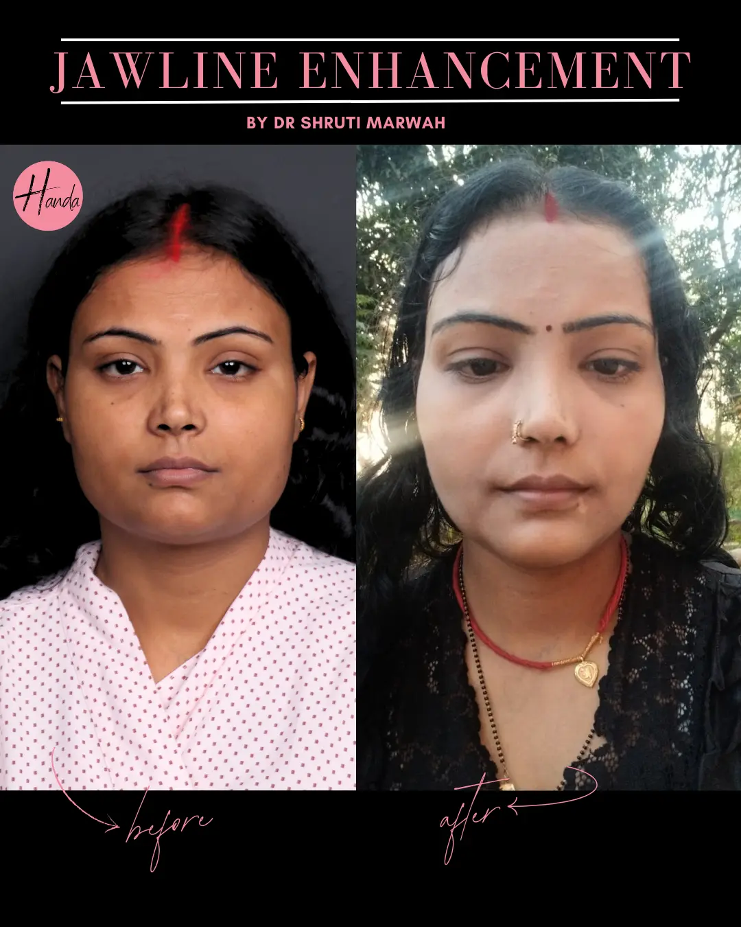 CHIN & JAWLINE LIPOSUCTION before and after — Handa Aesthetics