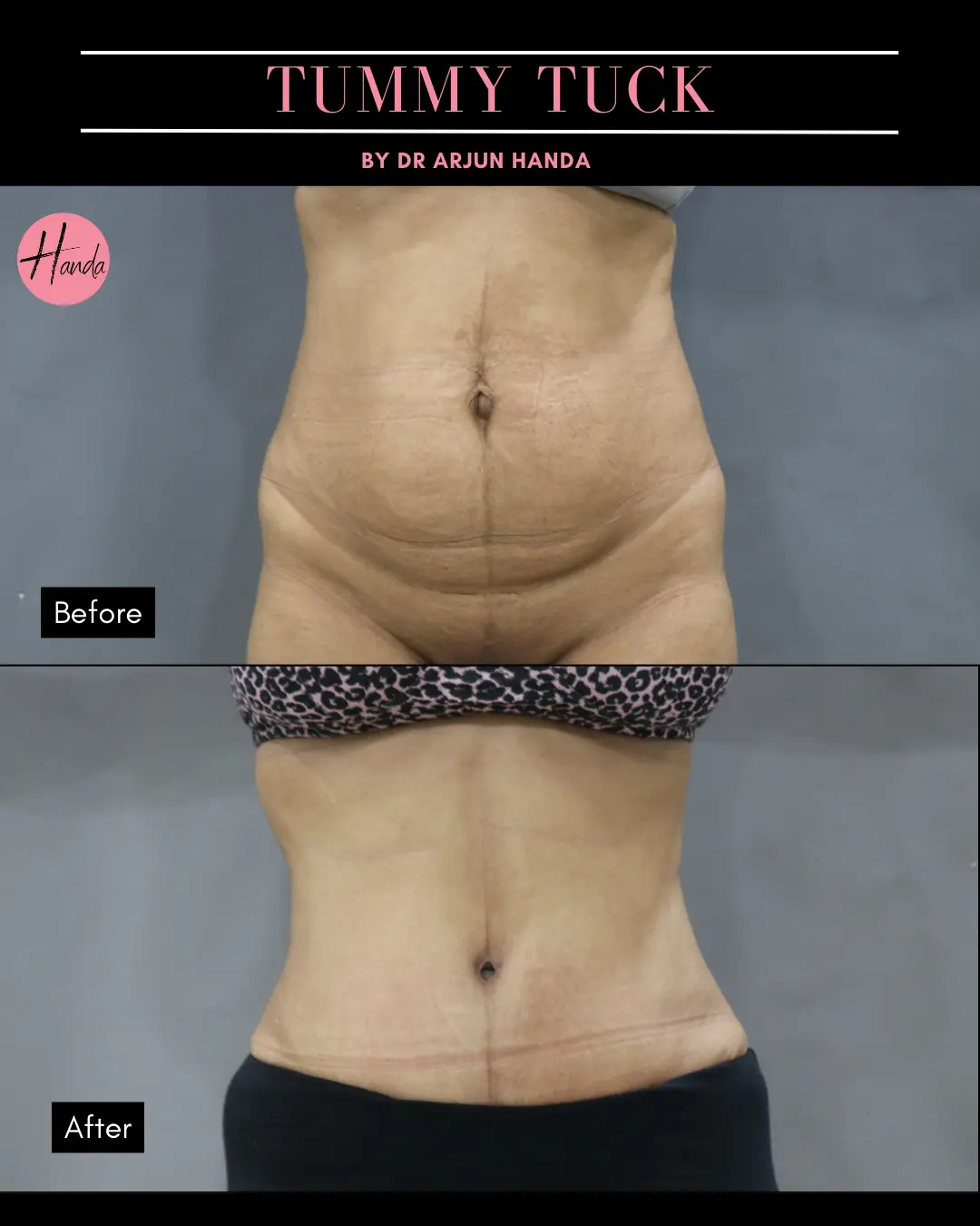 Tummy Tuck (Full Abdominoplasty) before and after — Handa Aesthetics