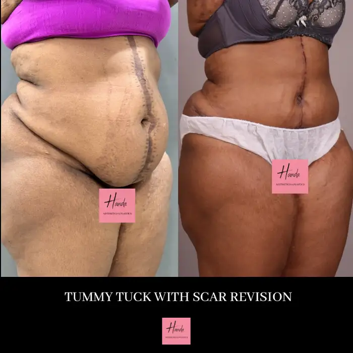 Tummy Tuck (Full Abdominoplasty) before and after — Handa Aesthetics