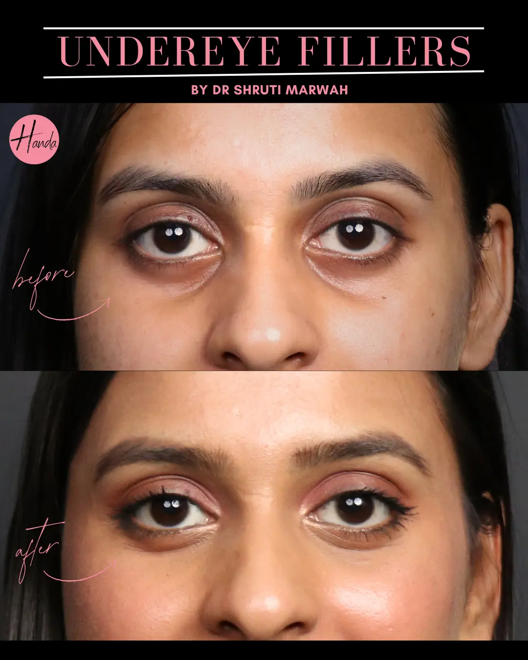 Face before and after — Handa Aesthetics