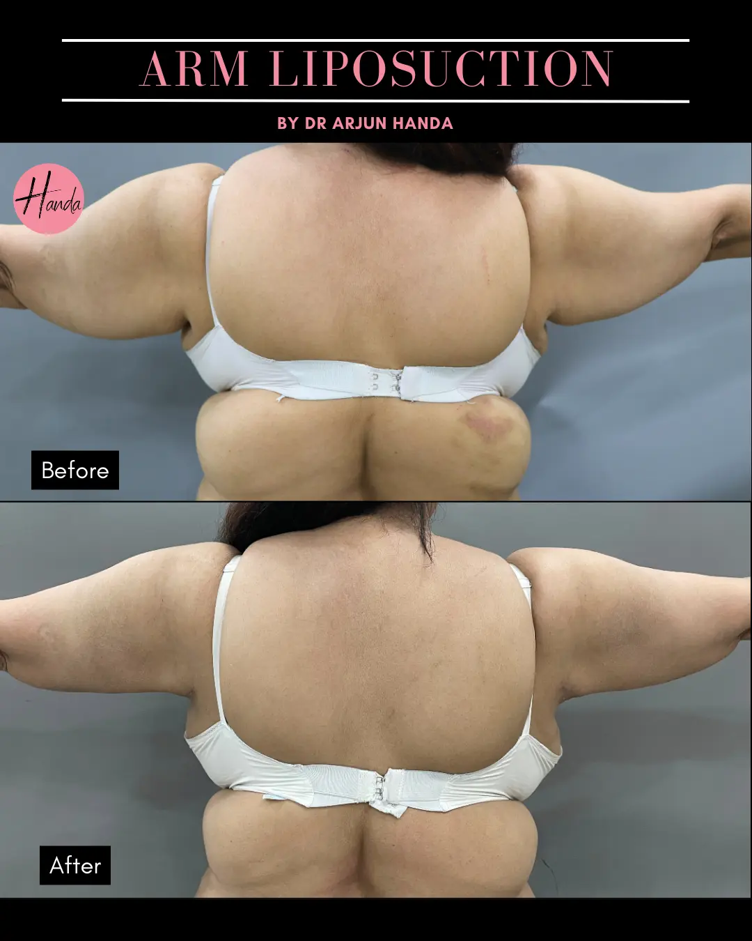 Arms & Thighs Lift before and after — Handa Aesthetics