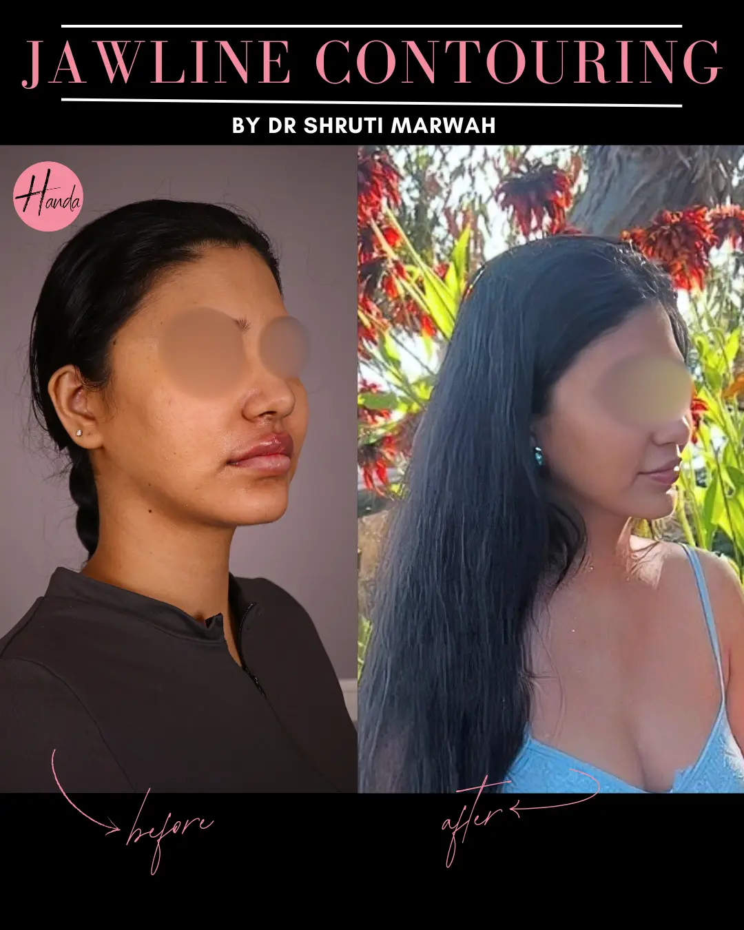 CHIN & JAWLINE LIPOSUCTION before and after — Handa Aesthetics