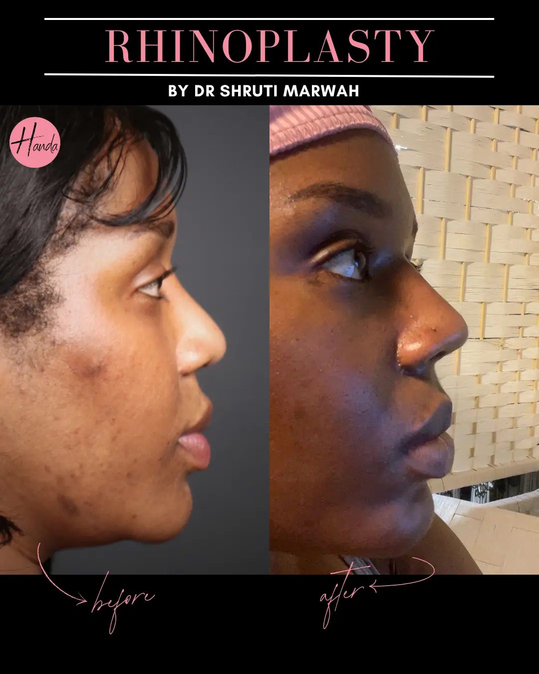 RHINOPLASTY before and after — Handa Aesthetics