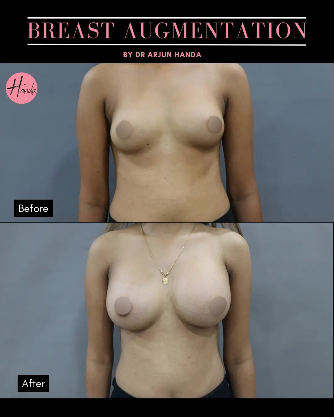 BREAST AUGMENTATION before and after — Handa Aesthetics