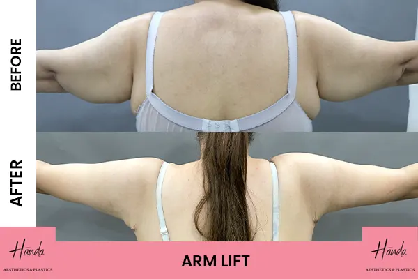 Arms & Thighs Lift before and after — Handa Aesthetics