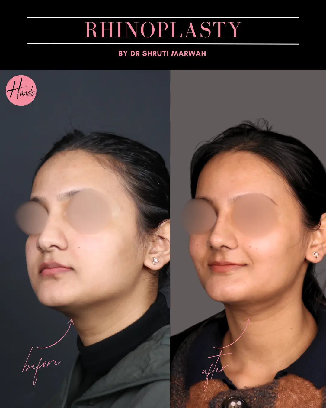 RHINOPLASTY before and after — Handa Aesthetics