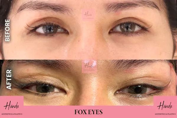 Body Contouring before and after — Handa Aesthetics