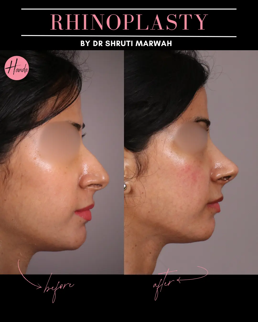RHINOPLASTY before and after — Handa Aesthetics