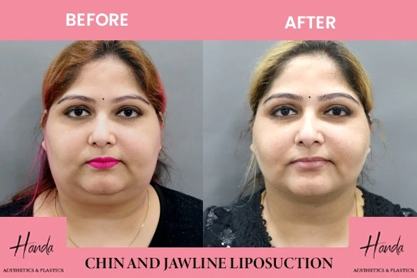 CHIN & JAWLINE LIPOSUCTION before and after — Handa Aesthetics