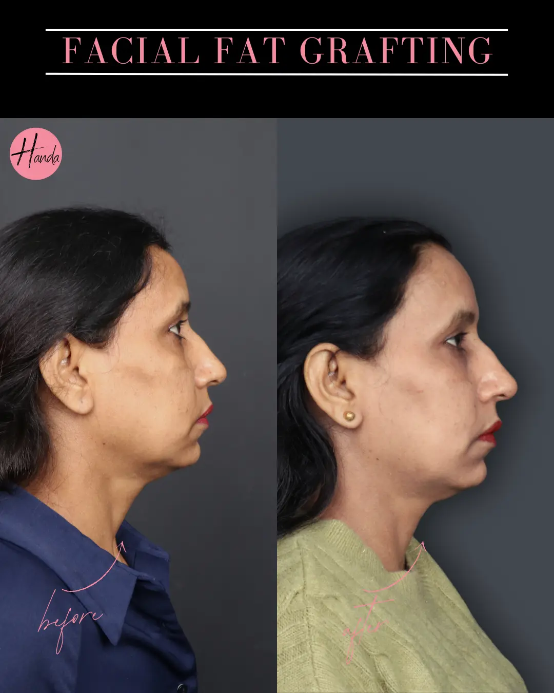 FACIAL FAT GRAFTING before and after — Handa Aesthetics