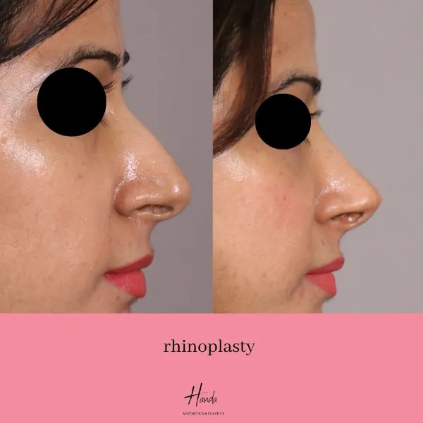 RHINOPLASTY before and after — Handa Aesthetics