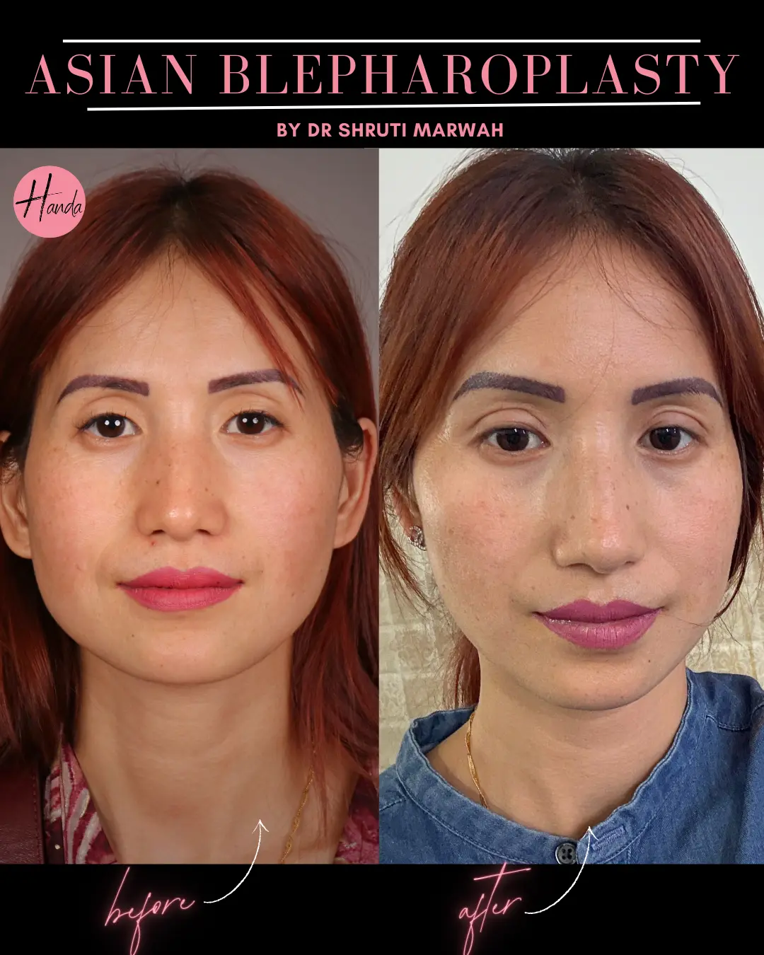 ASIAN BLEPHAROPLASTY before and after — Handa Aesthetics
