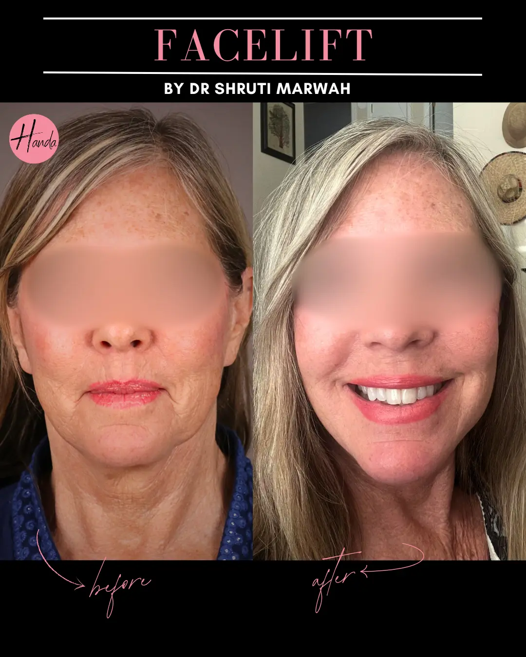 FACE LIFT before and after — Handa Aesthetics