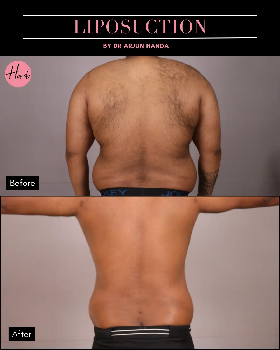 Liposuction before and after — Handa Aesthetics