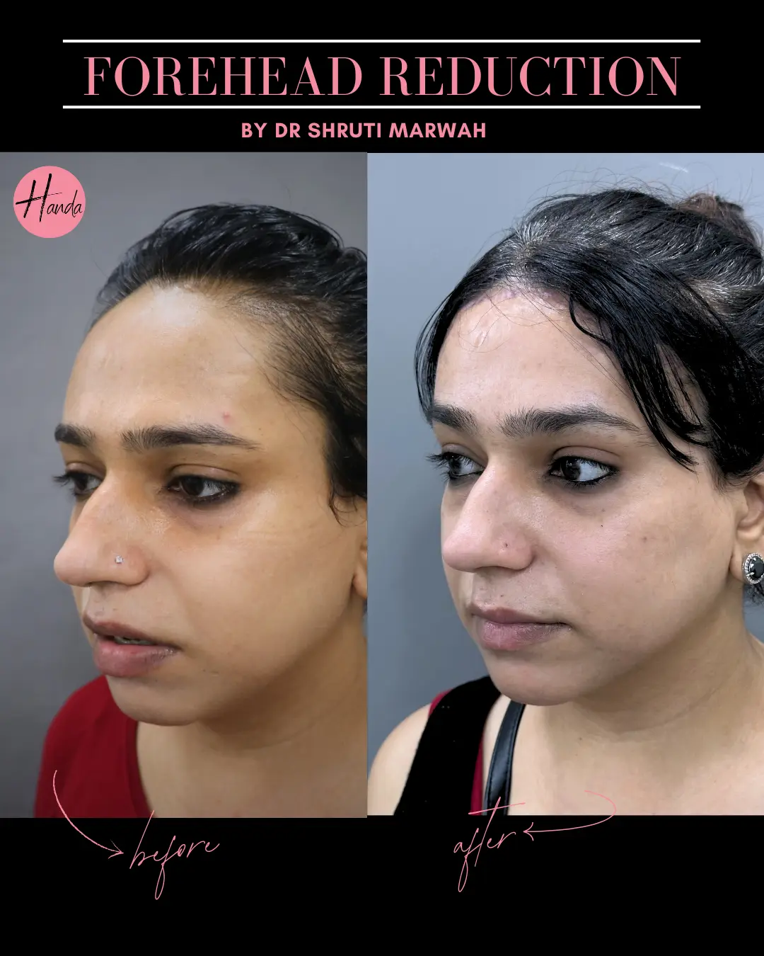 FOREHEAD REDUCTION before and after — Handa Aesthetics
