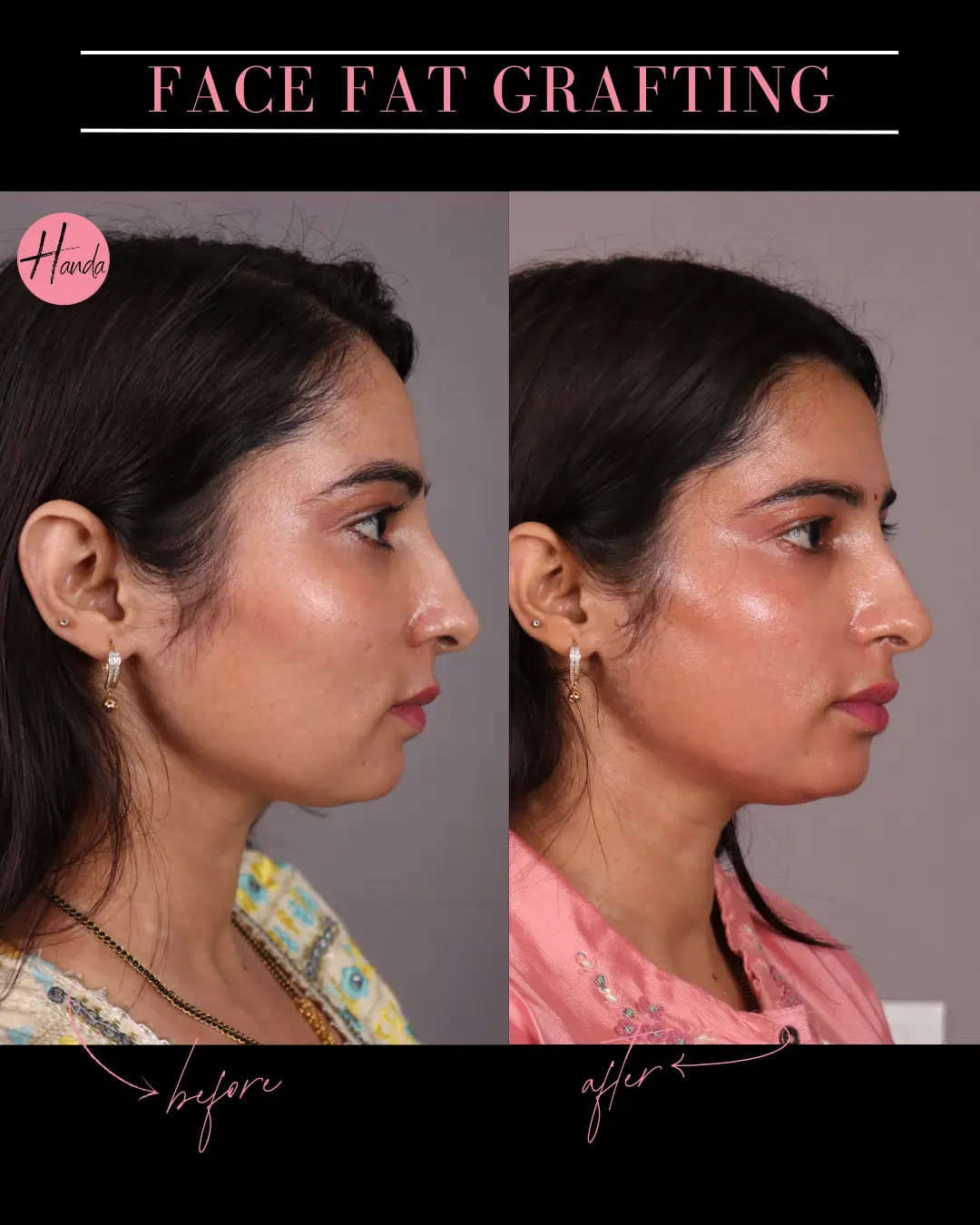 FACIAL FAT GRAFTING before and after — Handa Aesthetics
