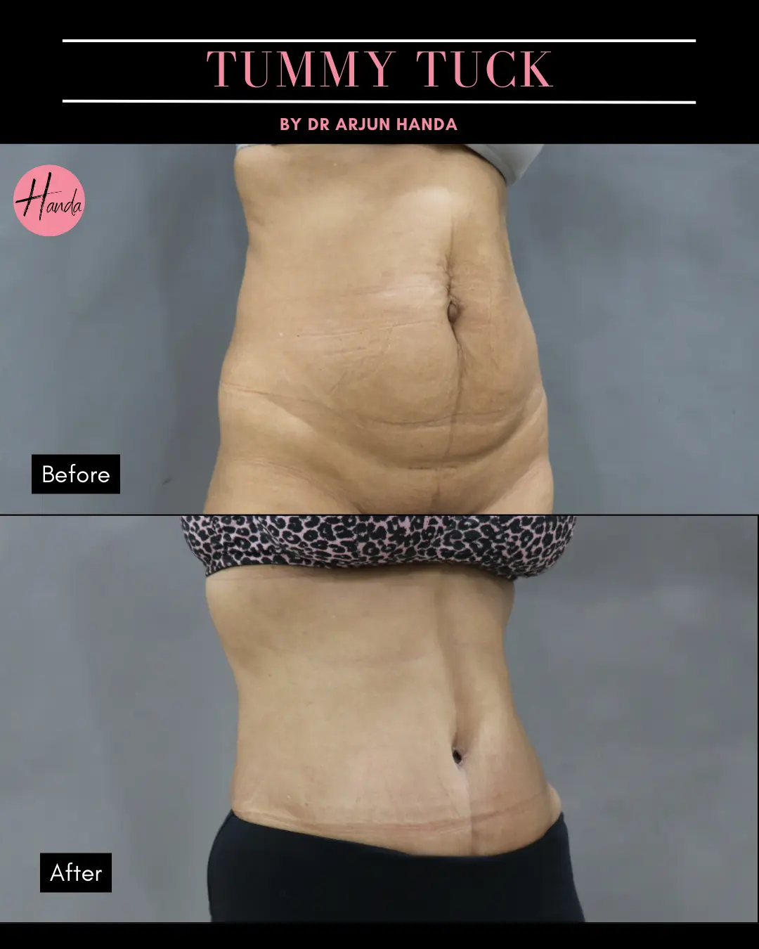 Tummy Tuck (Full Abdominoplasty) before and after — Handa Aesthetics