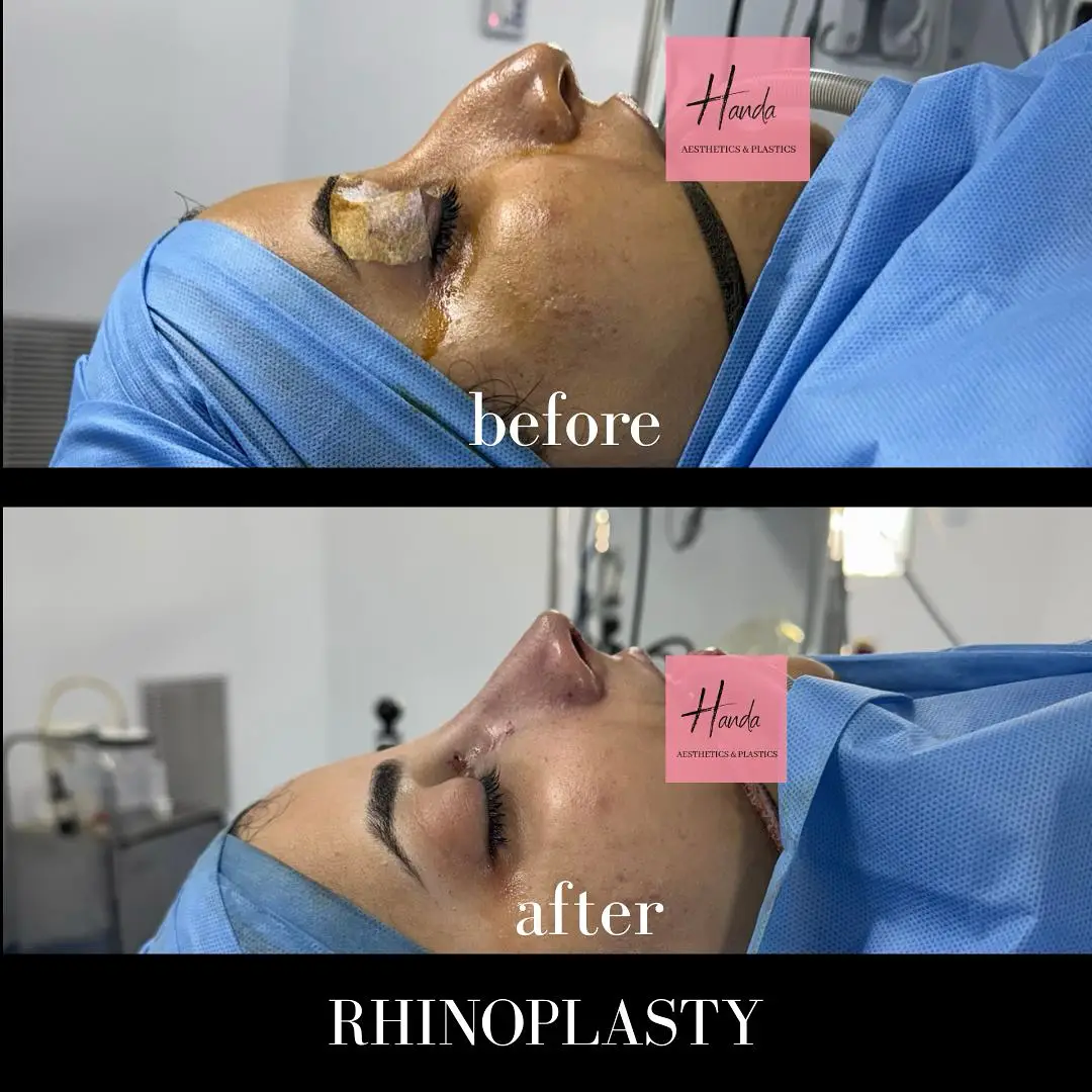 RHINOPLASTY before and after — Handa Aesthetics