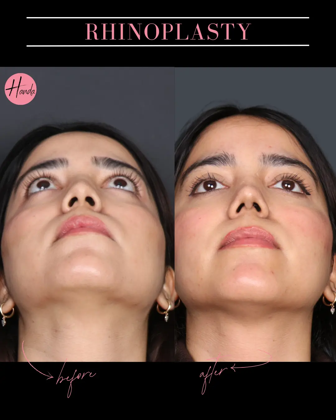 RHINOPLASTY before and after — Handa Aesthetics