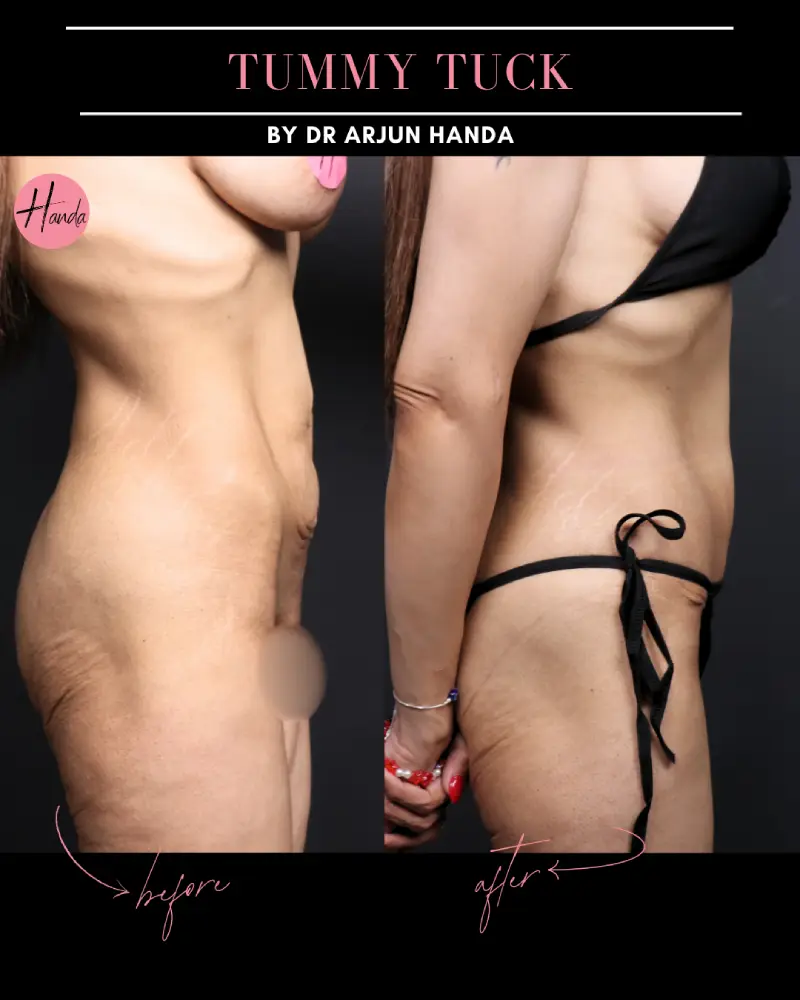 Tummy Tuck (Full Abdominoplasty) before and after — Handa Aesthetics