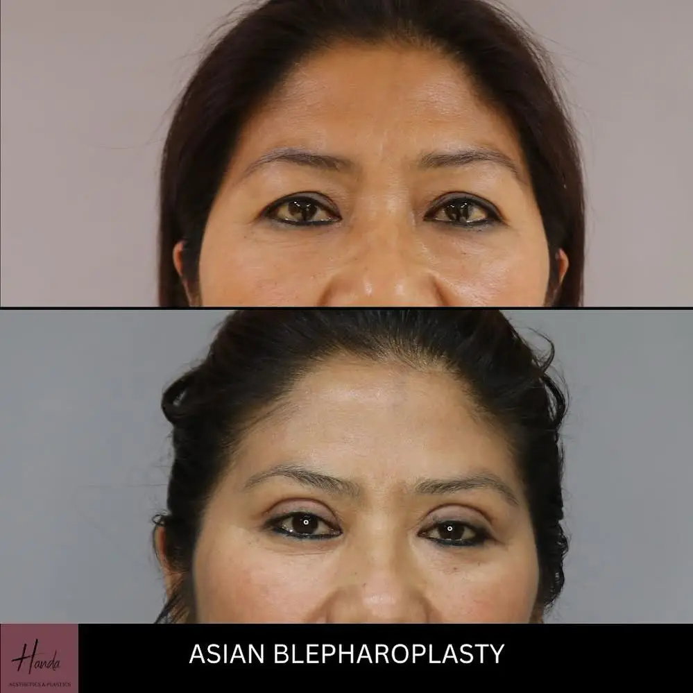 ASIAN BLEPHAROPLASTY before and after — Handa Aesthetics