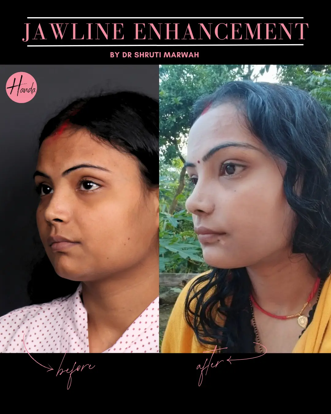 CHIN & JAWLINE LIPOSUCTION before and after — Handa Aesthetics