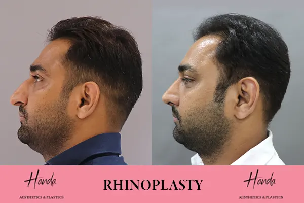 RHINOPLASTY before and after — Handa Aesthetics