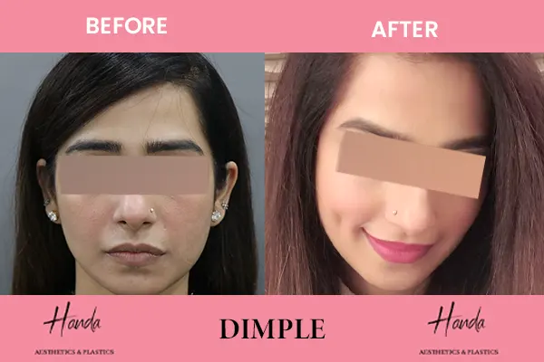 Body Contouring before and after — Handa Aesthetics
