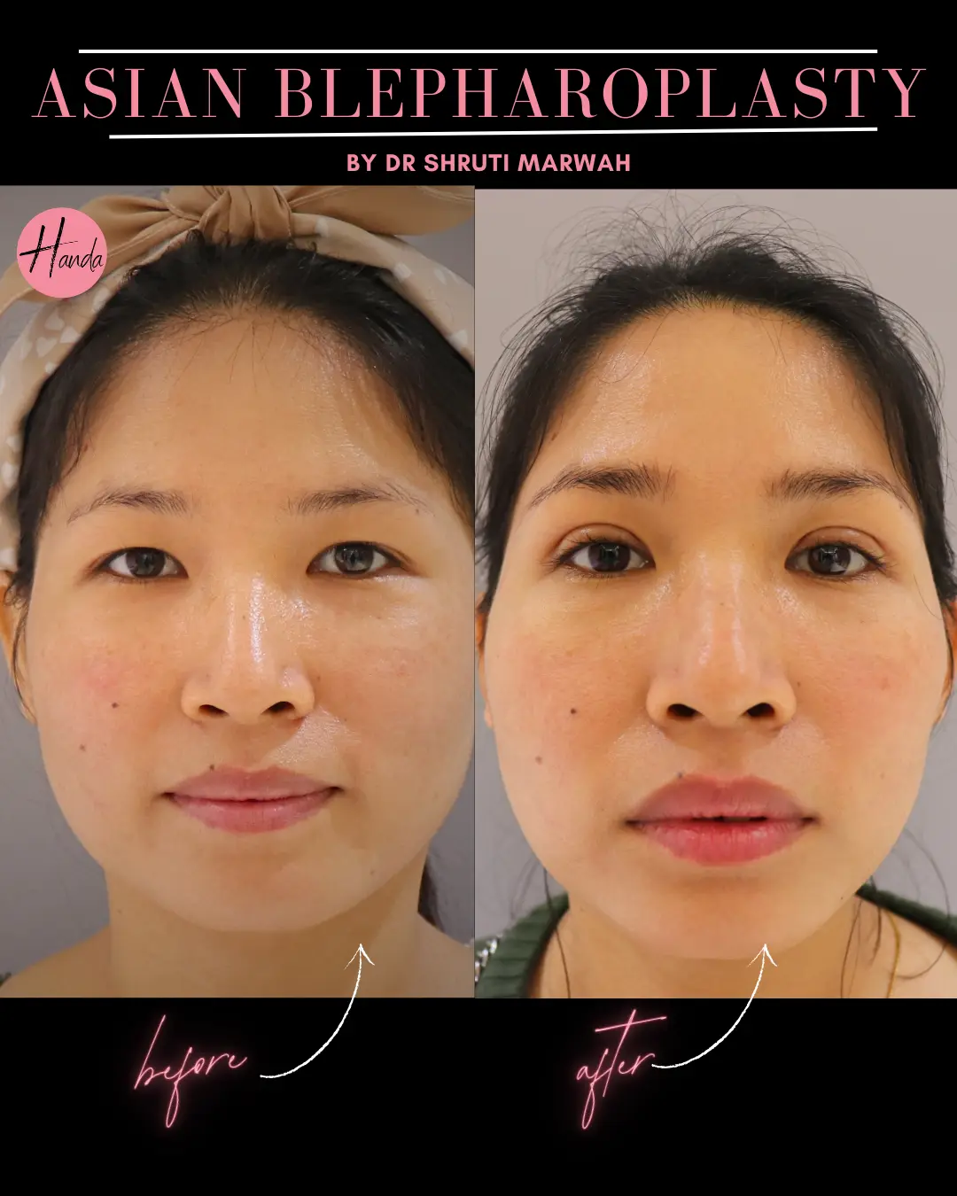 ASIAN BLEPHAROPLASTY before and after — Handa Aesthetics