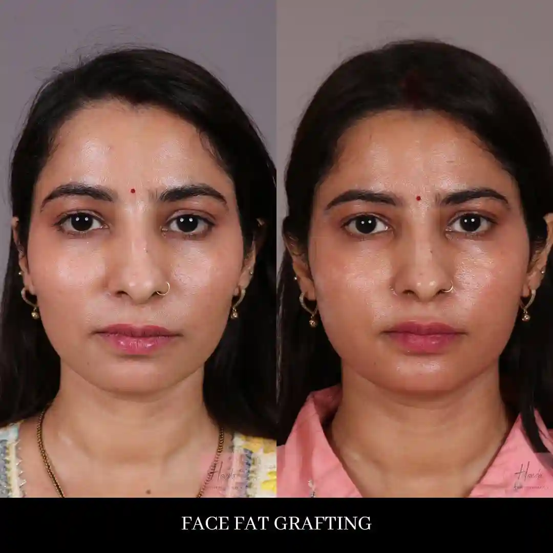 FACIAL FAT GRAFTING before and after — Handa Aesthetics
