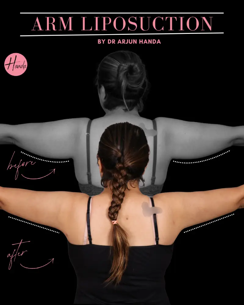 Arms & Thighs Lift before and after — Handa Aesthetics