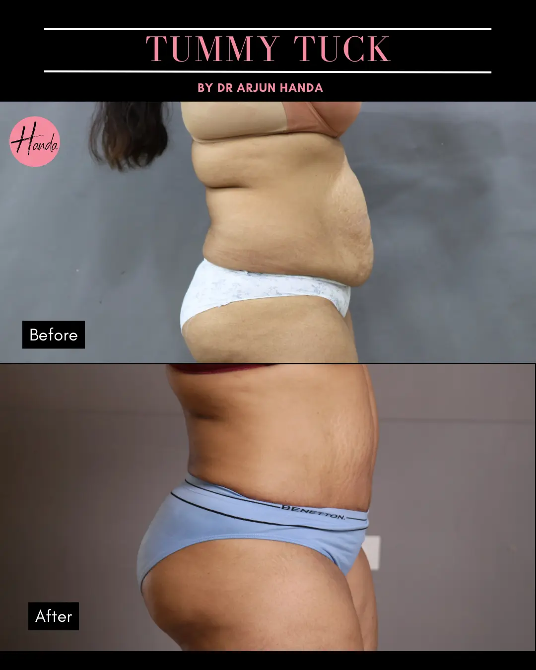 Tummy Tuck (Full Abdominoplasty) before and after — Handa Aesthetics