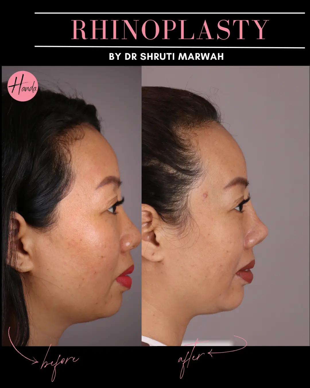 RHINOPLASTY before and after — Handa Aesthetics