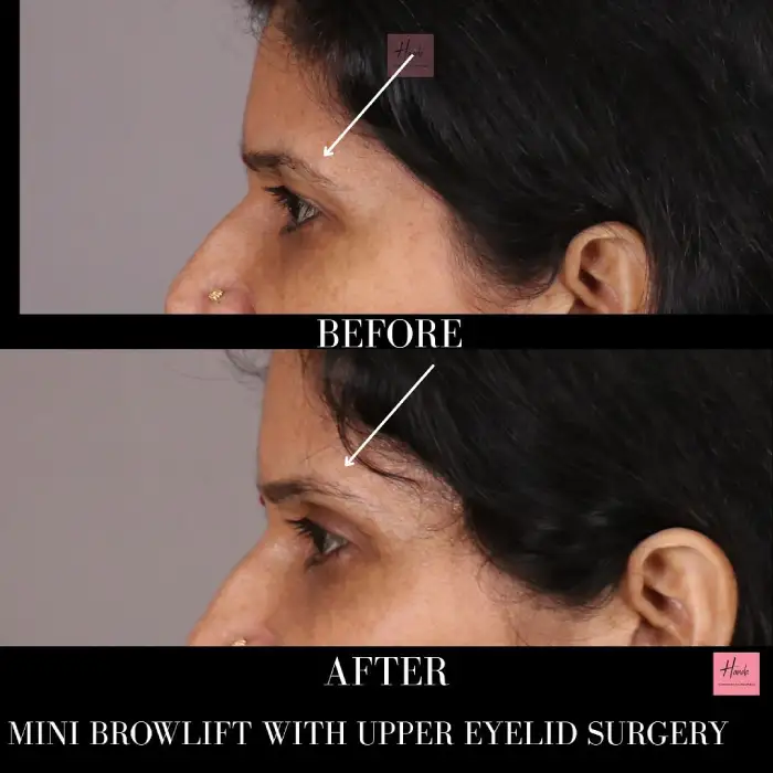 BROW LIFT before and after — Handa Aesthetics
