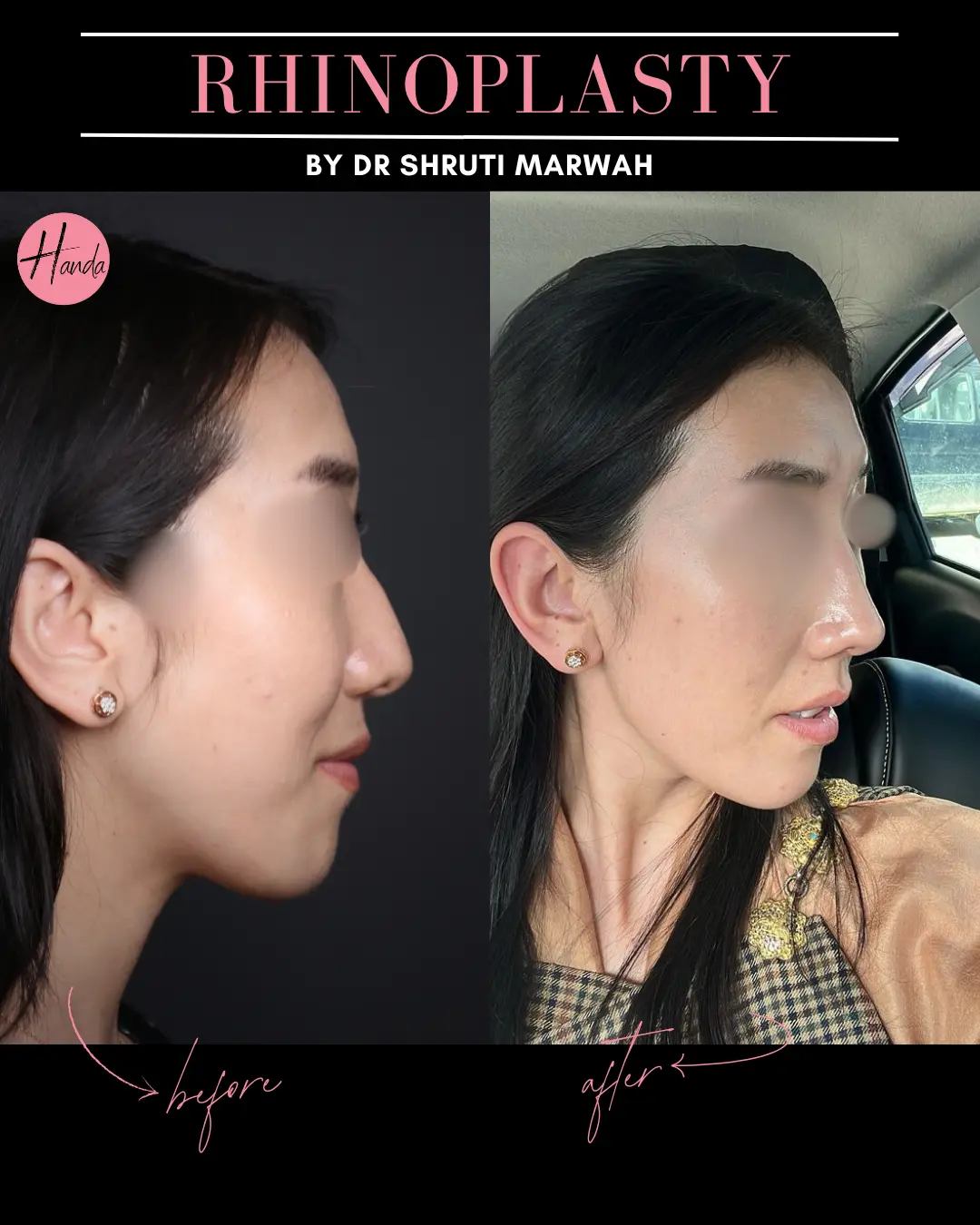 RHINOPLASTY before and after — Handa Aesthetics