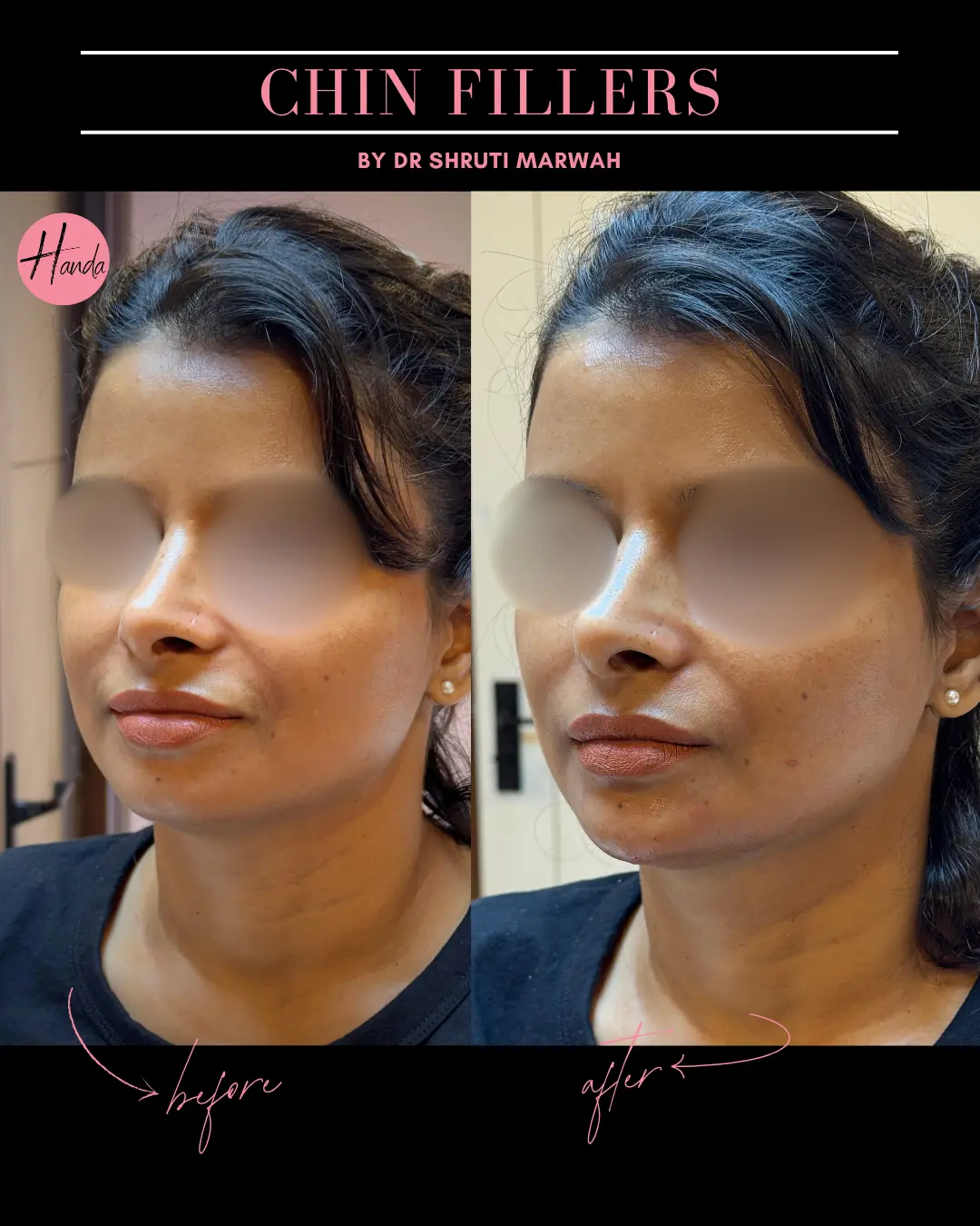 CHIN & LIP FILLERS before and after — Handa Aesthetics