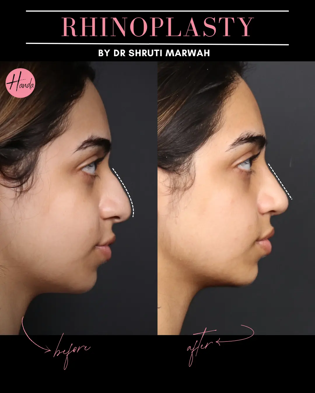 RHINOPLASTY before and after — Handa Aesthetics