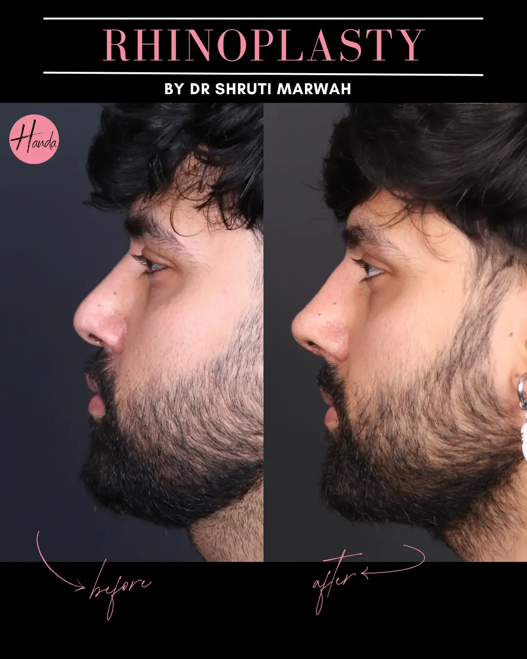 RHINOPLASTY before and after — Handa Aesthetics